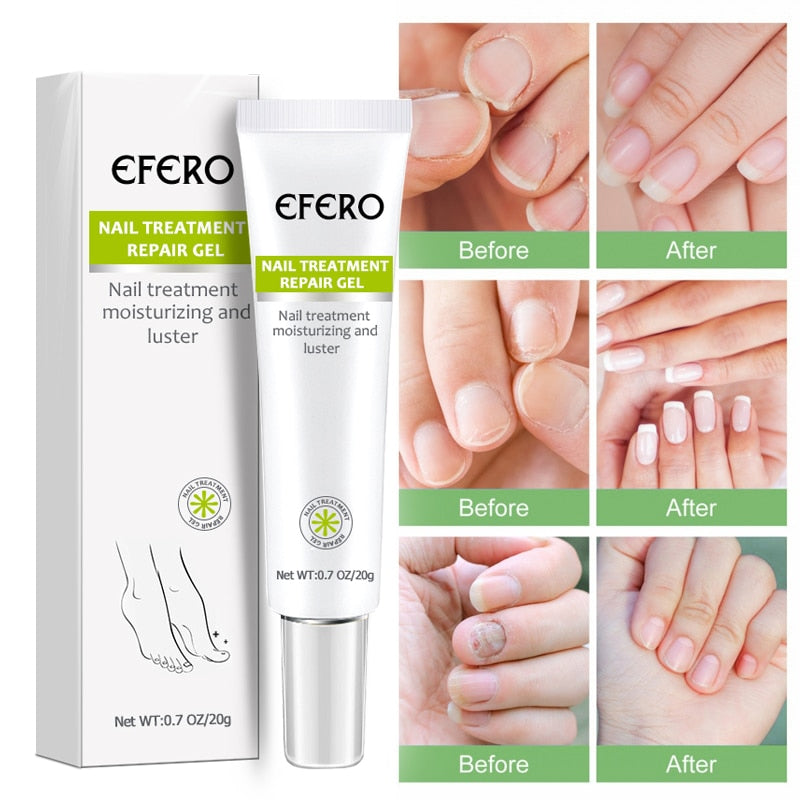 EFERO - Creme Anti - Inflamatório Para Remoção de Fungos + BRINDE